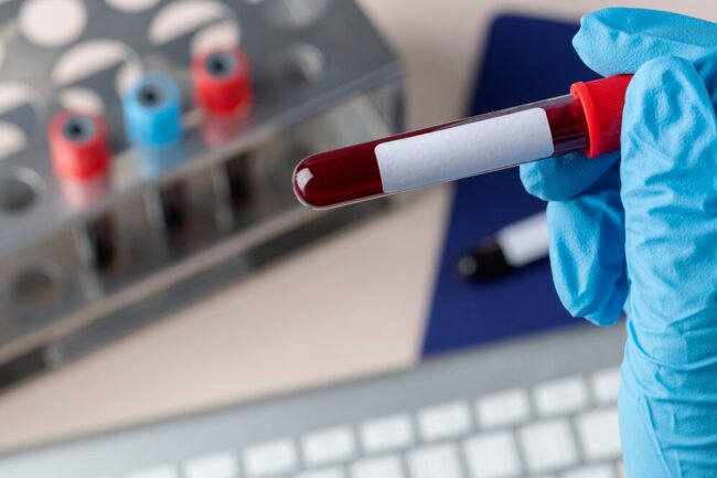 surgeon-holding-blood-test_53876-94763 آزمایش